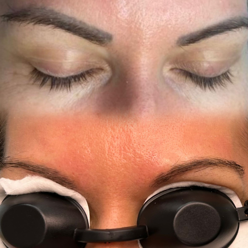  <span class="lte-header lte-h4"> Eliminare tatuaj sprâncene </span> 